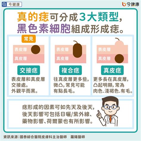 為什麼痣會長毛|是痣？皮膚癌？還是什麼？常見Q&A解惑！醫教揪出「假的痣」